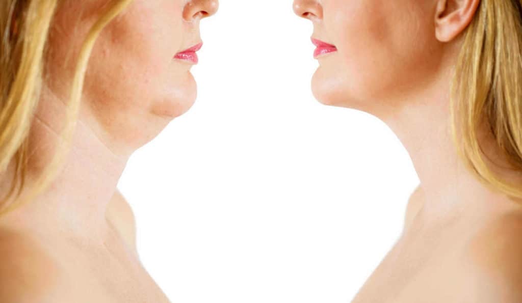 Double Chin treatment Reading before and after results