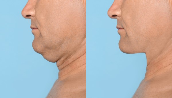 Which Non-Surgical Treatments Work Best for Jowls and Loose Skin Reading?