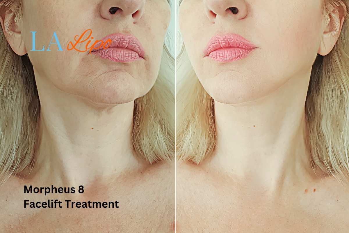 Turn back time with Morpheus8 Treatment Reading