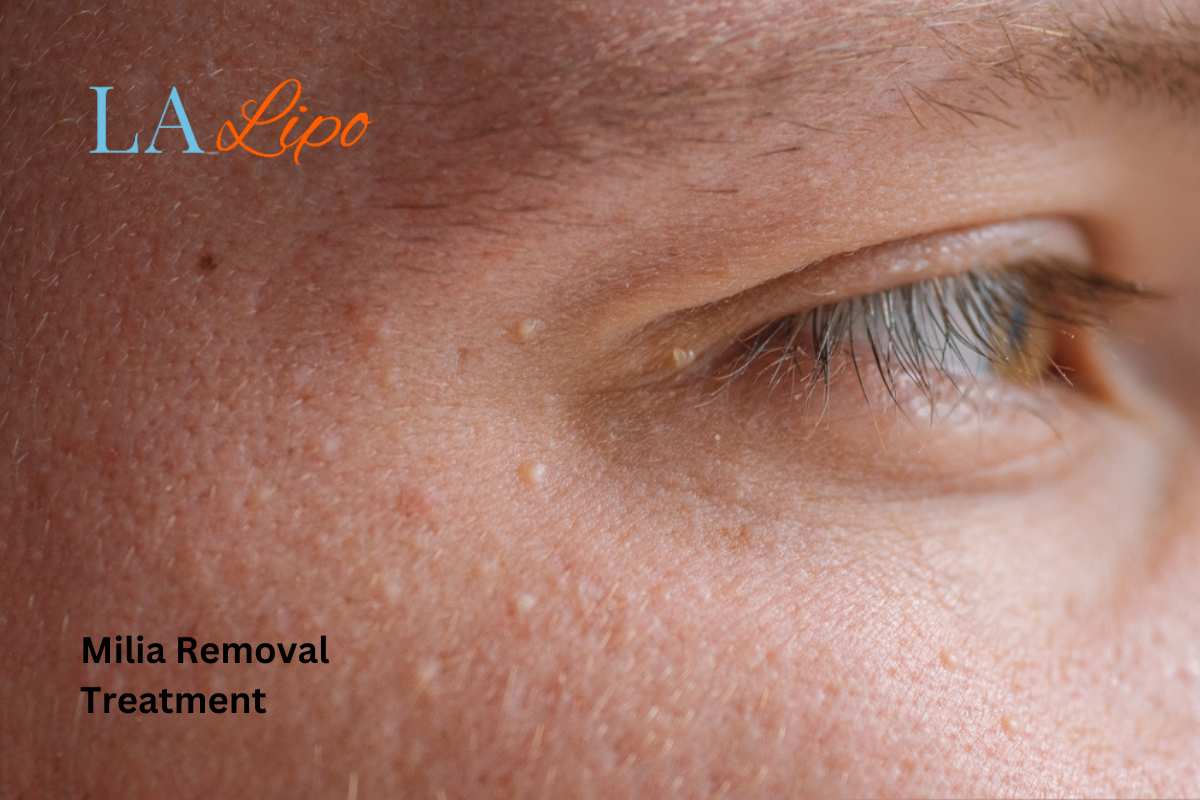 Cryopen Milia Removal: Is It the Easiest and Safest Option Reading?