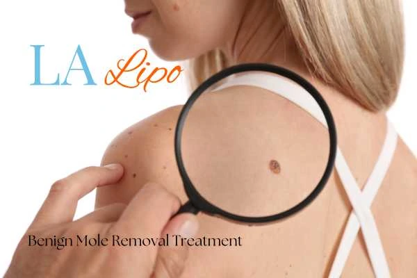 Why getting moles removed Reading can boost your confidence!