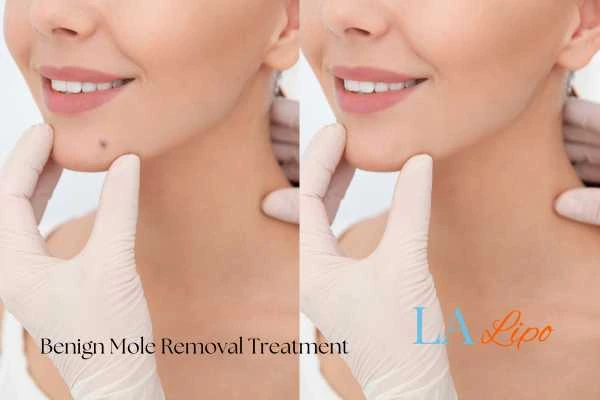 woman's before and after mole removal Reading results