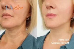 hi-fu for wrinkles Reading before and after results