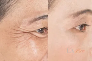 Before and after results of woman - HI-fu wrinkles reduction treatment Reading