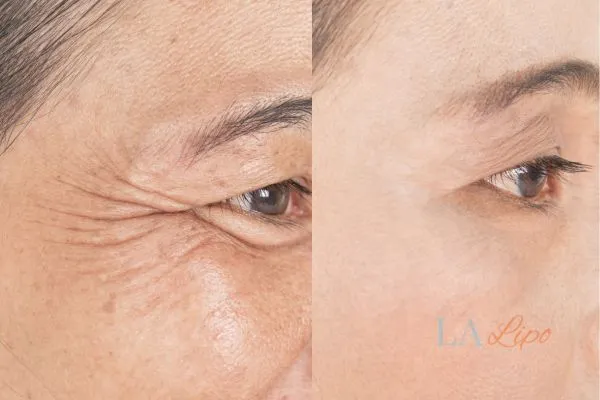 Before and after results of woman - HI-fu wrinkles reduction treatment Reading