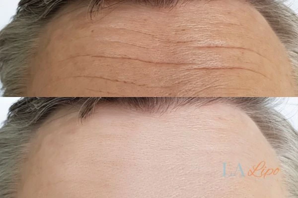 results of HIFU Reading on mans forehead to help reduce lines and wrinkles