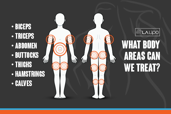 Graphic to show areas you can have LA-EMS Body Sculpting Reading treatment.
