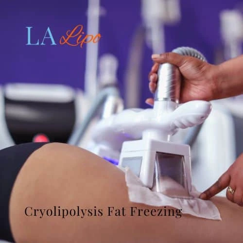 fat freezing - Cryolipolysis Reading