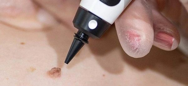 skin tag removal using cryopen Reading