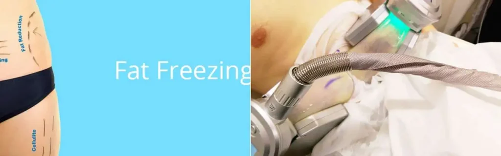 multi areas of a persons body having coolsculpting Reading treatment