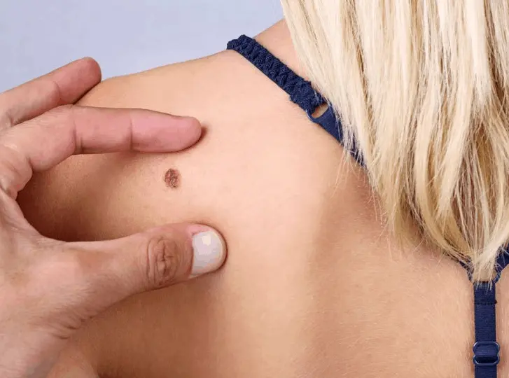 woman having mole removal Reading consultation before treatment.