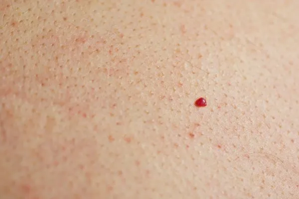 close up of a cherry angioma Reading