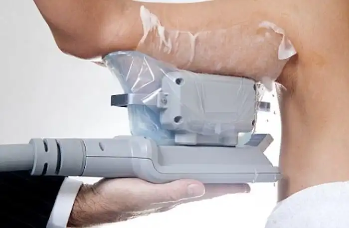 Picture of fat freezing Reading on the upper arms.