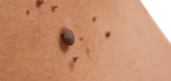 image of a skin tag Reading