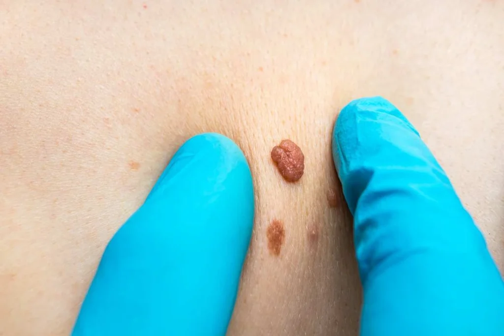 Consultant examining a skin tag Reading