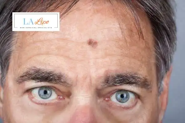 Solar Lentigo Removal Reading image of man with mark on his forehead