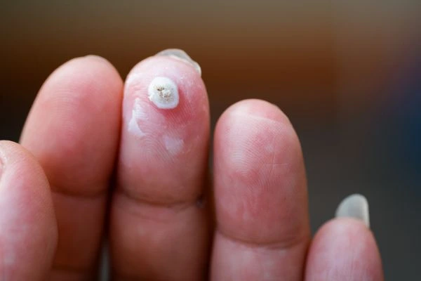 wart on person finger - cryotherapy to treat from LA LIPO Reading