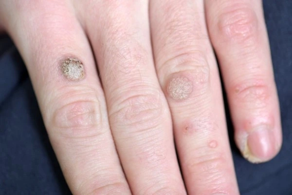 photo of warts on person hand - see wart removal Reading from LA LIPO