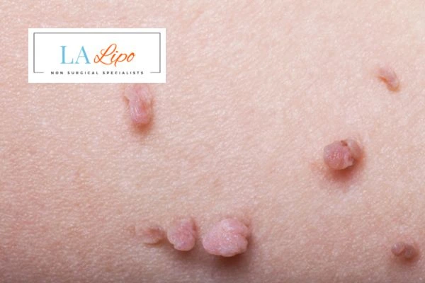 Does cryopen skin tag removal Reading hurt? Find out now call our team today!