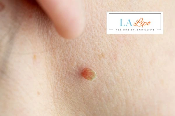Book skin tag removal Reading today speak to our team now!