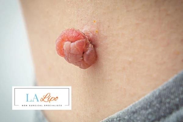Interested in skin tag removal Reading? Concerned about the pain? Find out more today!