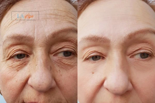 The powerful benefits of Morpheus8 Treatment Reading - Call Our team today!