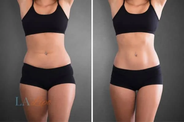 before and after results of non-surgical treatment to help a woman's body image and mental health Reading