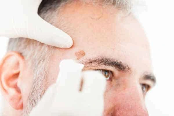 Age spots and elderly people Reading what is the link?