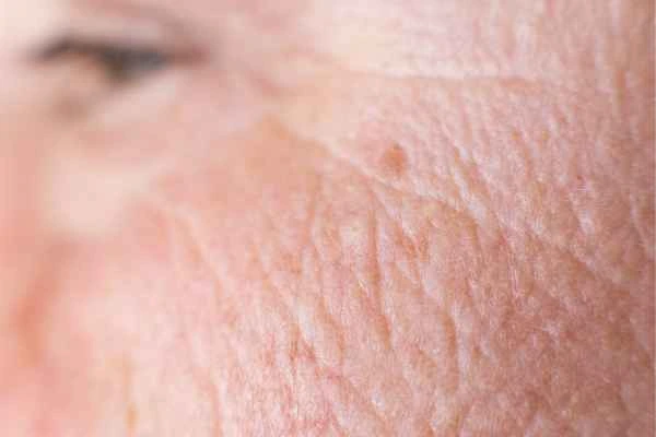 close up picture of a woman's face showing an age spot Reading