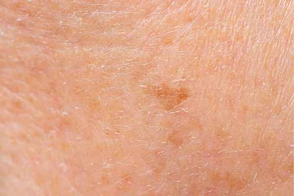 close up picture of age spots Reading