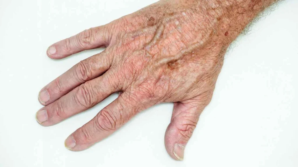 Male hand showing age spot Reading