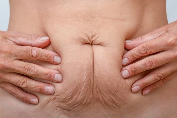 Image of a woman's stomach with loose skin - example of skin tightening Reading options