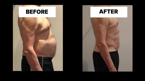 What Symptoms Can Diastasis Recti Cause in Men? Weak Core, Back Pain and Poor Posture Reading